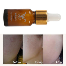 10ml Essence full-body whitening chicken skin repair essential oils remove dead skin goose bumps pimples folliculitis SM6